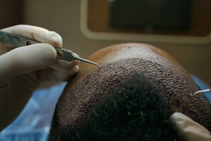 Hair transplantation in Iran / Hair loss treatment with the lowest cost	