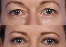 Eyes with fallen eyelids treatment