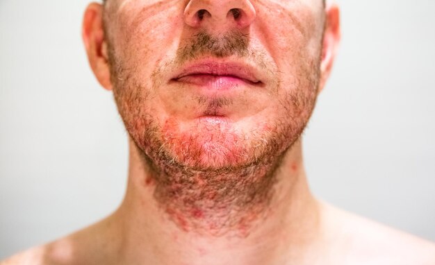 5 Effective Ways to Minimize Facial Swelling after Beard Transplantation